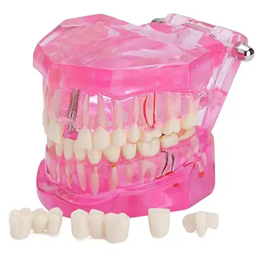 LVCHEN Transparent Dental Implant Teeth Model   Transparent Disease Teeth Model Pathological Tooth Model with Removable Teeth for Dental Study and Education