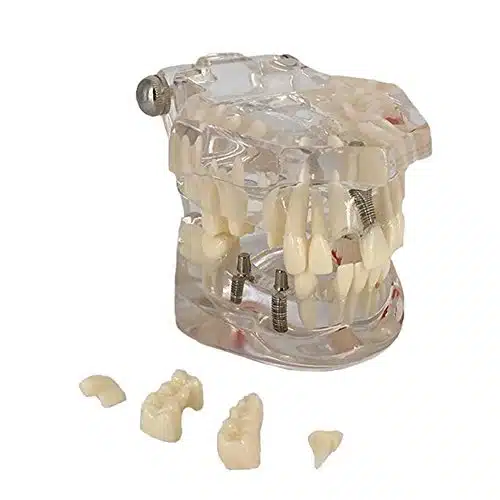 Transparent Dental Implant Disease Teeth Model Dentist Standard Pathological Removable Tooth Teaching Model Tools