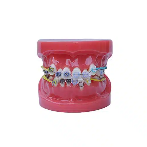 Sino Dental Typodont with Braces Orthodontic Teeth Model with Half Metal Bracekets and Half Ceramic Braces